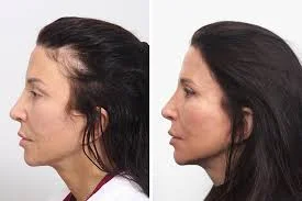 women before and after hair transplant